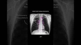 Heart Anatomy on Chest X-Ray - Shorts