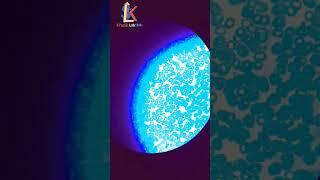 macrocytic hypochromic RBC,s.