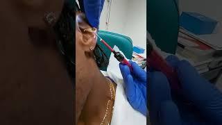 Crazy earwax removal (Ear cleaning)