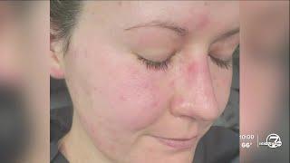 Woman still recovering after rare, extreme complications from West Nile virus