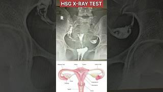 HSG X-RAY TEST( BOTH FALLOPIAN TUBE PATENT ) #hsgtest #gynecology #radiology  #xray #tube #fallopian