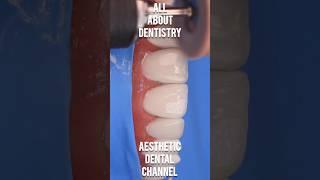 Dental motivation. Composite veneers. #dentistry #dental #dentaltreatment
