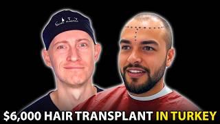 I Got a Hair Transplant in Turkey ($6,000) | Hair Surgeon Reacts
