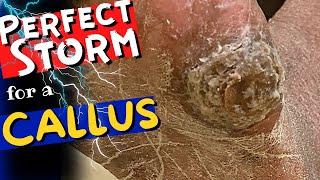 The Perfect Storm For a Callus: Diabetes, Neuropathy, Dry Skin, and Fat Pad Loss