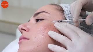 Инъекции Ботокс (Botox), Коррекция ботулотоксинами (видео №3)