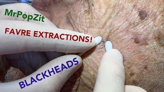 FAVRE-RACOUCHOT Blackhead extractions! Thickened skin pore plugs removed. Pore cleansing activated!