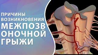   Причины возникновения межпозвоночной грыжи // Грыжа позвоночника // #грыжа #грыжадиска