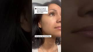Here are three signs of well-placed lip filler: Natural Shape and Contour - The lips maintain a
