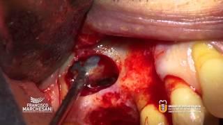 Sinus lift Implant connection after six months.
