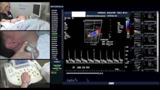 Carotid Protocol (Esther Collado, RN, RVI)