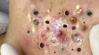 Big Cystic Acne Blackheads Extraction Blackheads & Milia, Whiteheads Removal Pimple Popping #