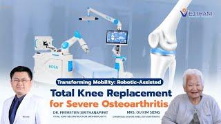 Transforming Mobility: Robotic-Assisted Total Knee Replacement for Severe Osteoarthritis