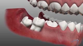 Wisdom Tooth Removal Information in Odessa TX | Permian Basin Oral Surgery & Dental Implant Center