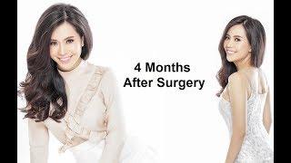 Annie Vu (Vũ Ngọc Ánh) Rhinoplasty and Mouth Line Fat Grafting | Seoul Guide Medical