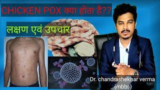 What is chicken pox ?? prevention , and treatment / Dr.chandrashekhar verma (mbbs)