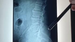 How to read Lumbar Spine X-ray, Disc Bulge in X-ray? Low Back Pain Xray