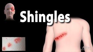 Shingles: Pathophysiology, Symptoms, 3 stages of Infection, Complications, Management, Animation.