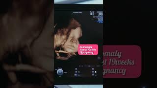 3D anomaly scan at 19weeks of pregnancy #ultrasound #pregnancy #shorts