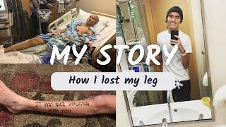 How I Lost My Leg - My Cancer Story