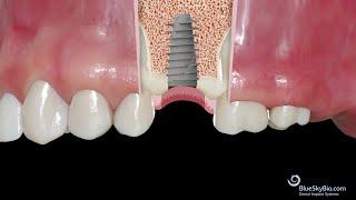 BSB Bio Max Forte 4.3 Implant