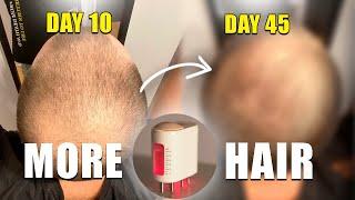 I Used the Follicle Activator for 45 Days – Before & After Results! Does It Work? Honest Review!