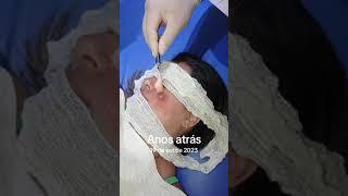 Botfly Maggot Removal #spa #doctor #satisfying #pimple #removal