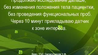 Частичная эвакуация тромба из ствола большой подкожной вены  в просвет общей бедренной вены