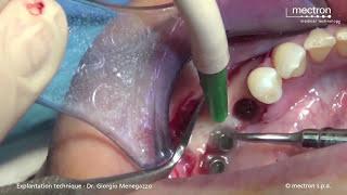 PIEZOSURGERY - Dr. Giorgio Menegazzo - Removal of implants