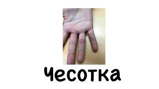 Чесотка. Сыпь. #чесотка#сыпь#подготовкакusmle