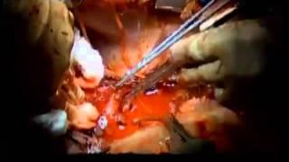 A Simple System for Video of Open Surgical Cases