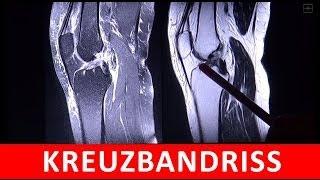 Kreuzbandriss - MRT MRI Darstellung - by Radiologie TV