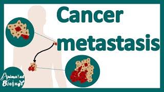 Cancer Metastasis | cancer metastasis mechanism | Metastasis | How do cancers spread in the body?