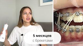 5 МЕСЯЦЕВ С БРЕКЕТАМИ: Лафа кончилась  Нужен ли ИРРИГАТОР?  || Для чего НАКЛАДКИ?