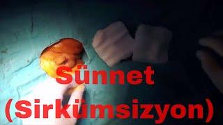 Sünnet Nasıl Yapılır Ameliyat Videosu izle