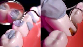 ASMR 1 Hour of Teeth Scaling ⎢ Deep Dental Cleaning  ⎢ Dental Pick (No Talking)