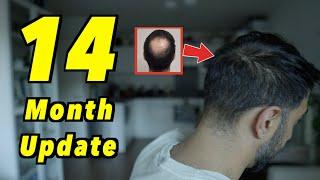 14 Month 2nd Hair Transplant Update | 4000 GRAFTS FUE | SLOW AND STEADY