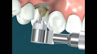 Dental Video of Crown Lengthening Broken Tooth