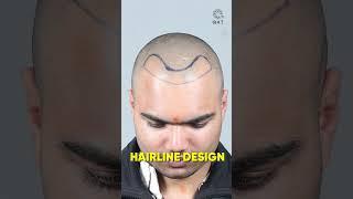 Amazing Hair Transplant Surgery | Latest Fue Technique #shorts #viral #hair transplant
