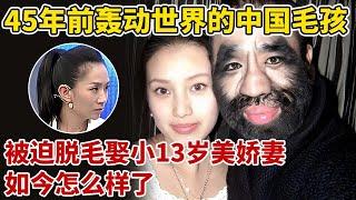 45年前,那个轰动全世界的“毛孩”,42岁被迫脱毛娶小13岁美娇妻,如今怎么样了?【王芳王为念访谈】#于震寰