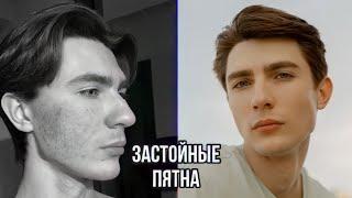 Как убрать застойные пятна? | Пигментные пятна | Постакне