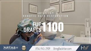 Hair By Dr. Max, Restoration Center - 1100 FUE Grafts ARTAS® Robotic Hair Restoration