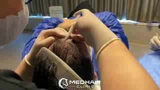 DHI Hair Transplant