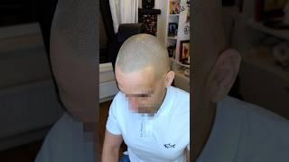 Маскировка облысения надолго трихопигментация тату волос SMP scalp micropigmentation