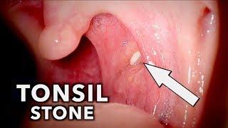 TONSIL STONE + A Touch of Pneumonia | Dr. Paul