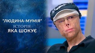 ЧЕЛОВЕК-МУМИЯ: Уникальный случай, который ШОКИРУЕТ весь мир! "Говорить Україна". Архів