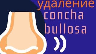 Резекция concha bullosa (Садыхов Р.А.)