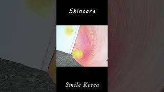 Skincare, ingrown hair removal, and treatment of facial pustules #shorts#smile korea#skincare#asmr