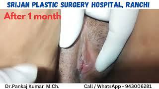 Designer vegina - Genital cosmetic surgery| Labiaplasty & Hymenoplasty Surgery in Ranchi