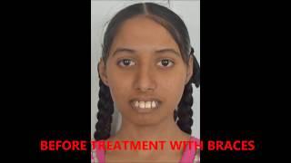 BEST BRACES TREATMENT IN KONDAPUR /SHERILINGAMPALLI BEST DENTIST/ORTHODONTIST VK DENTAL CLINIC