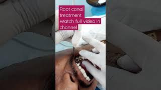 #rootcanaltreatment #doctors #rootcanaltreatment #doctors #toothcavity #zirconiacrown #rct #filling